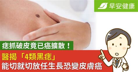 痣突出來|是痣or皮膚癌？醫「1張圖秒對照」 長這2部位最危險